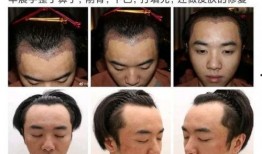 大麦植发爆料视频,揭秘植发手术背后的秘密